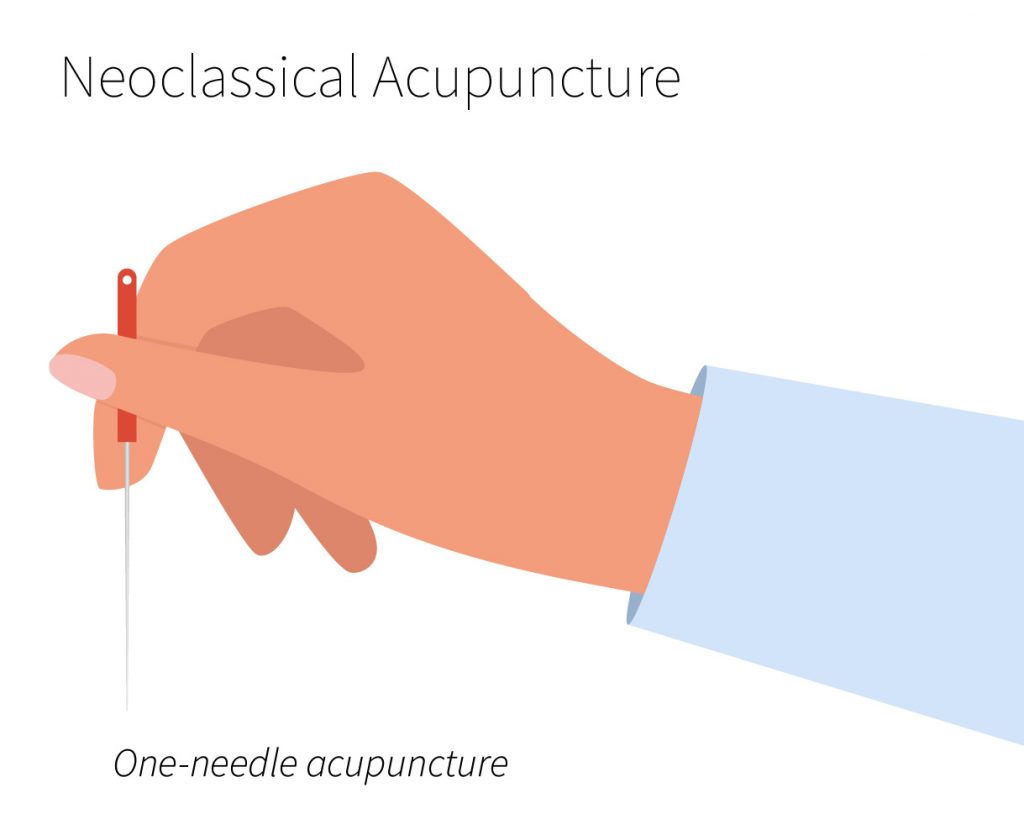 Neoclassical Acupuncture = One-needle acupuncture
